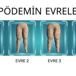 lipödemin_evreleri_103028733