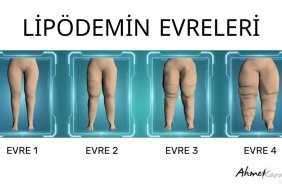 lipödemin_evreleri_103028733