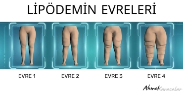 lipödemin_evreleri_103028733