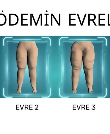 lipödemin_evreleri_103028733