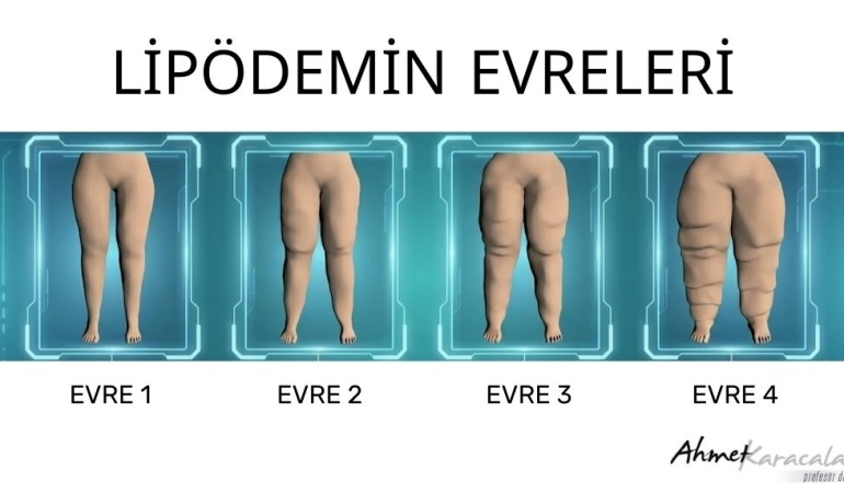 KİLO VEREMİYORSANIZ SUÇLU İRADENİZ DEĞİL, LİPÖDEM OLABİLİR