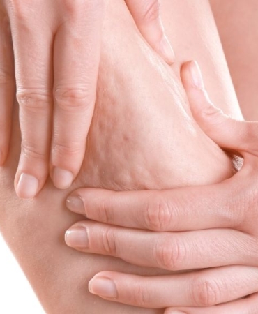 selülit-tedavisi_095925851