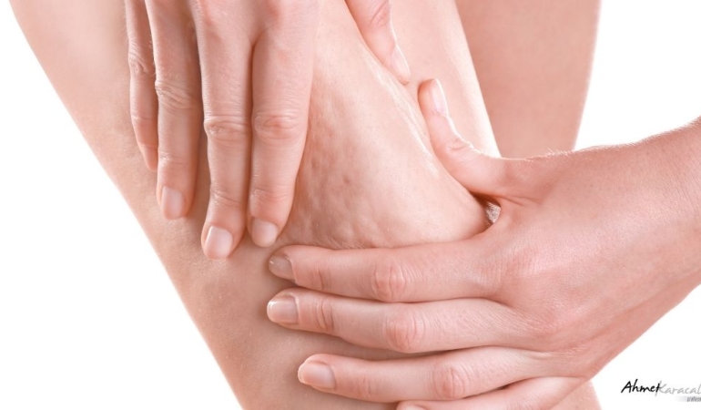 PROF. DR. AHMET KARACALAR: “SELÜLİT SADECE SELÜLİT DEĞİLDİR; METABOLİK BİR AYNADIR”