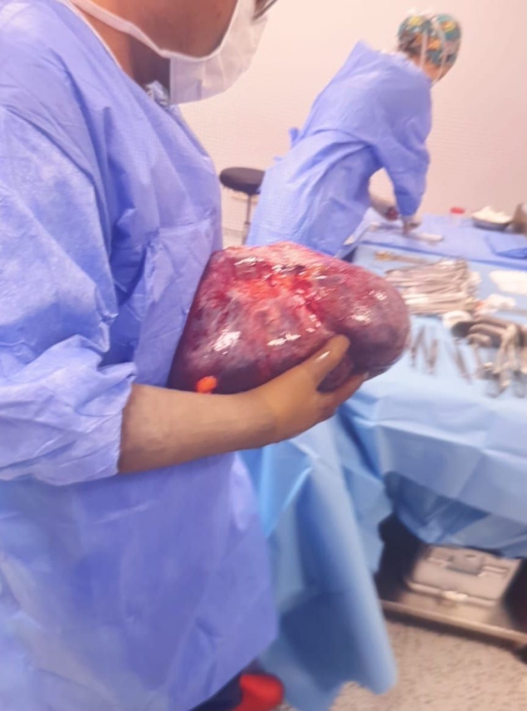14 kiloluk tümör ameliyatı sonrası dikkat çeken iyileşme hikâyesi